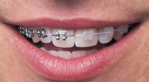 Zwei Arten Keramikbrackets